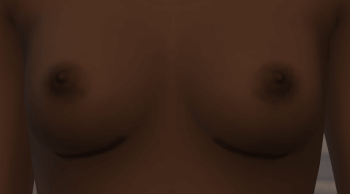 Inframammary Breast Augmentation Scars (Underboob Boobjob Scars)